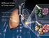 Lungenkrebs (Lung Cancer) GF1